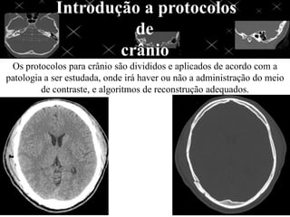 Introdução a protocolos
de
crânio
Os protocolos para crânio são divididos e aplicados de acordo com a
patologia a ser estudada, onde irá haver ou não a administração do meio
de contraste, e algoritmos de reconstrução adequados.
 