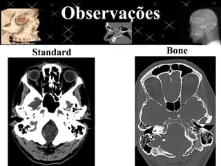 Observações
Standard Bone
 