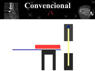 Convencional
 