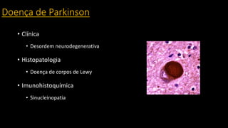 Doença de Parkinson
• Clínica
• Desordem neurodegenerativa
• Histopatologia
• Doença de corpos de Lewy
• Imunohistoquímica
• Sinucleinopatia
 