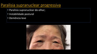 Paralisia supranuclear progressiva
• Paralisia supranuclear do olhar;
• Instabilidade postural
• Demência leve
 