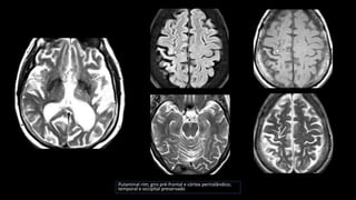 Putaminal rim; giro pré-frontal e córtex perirolândico;
temporal e occipital preservado
 