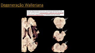 Degeneração Walleriana
 