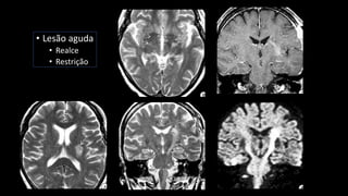 • Lesão aguda
• Realce
• Restrição
 