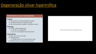 Degeneração olivar hipertrófica
 