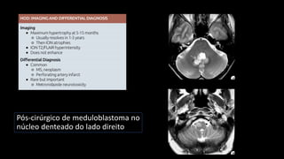 Pós-cirúrgico de meduloblastoma no
núcleo denteado do lado direito
 