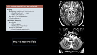 Infarto mesencéfalo
 