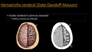 Hemiatrofia cerebral (Dyke-Davidoff-Masson)
• Insulto cerebral in utero ou neonatal
• Infarto, trauma ou infecção
 