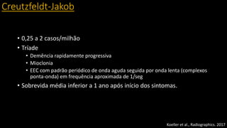 Creutzfeldt-Jakob
• 0,25 a 2 casos/milhão
• Tríade
• Demência rapidamente progressiva
• Mioclonia
• EEC com padrão periódico de onda aguda seguida por onda lenta (complexos
ponta-onda) em frequência aproximada de 1/seg
• Sobrevida média inferior a 1 ano após início dos sintomas.
Koeller et al., Radiographics. 2017
 