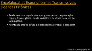 Encefalopatias Espongiformes Transmissíveis
Doenças Priônicas
• Perda neuronal rapidamente progressiva com degeneração
espongiforme, gliose, perda sináptica e ausência de resposta
inflamatória.
• Acentuada atrofia difusa do parênquima cerebral e cerebelar.
Koeller et al., Radiographics. 2017
 