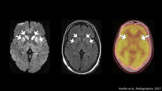Koeller et al., Radiographics. 2017
 