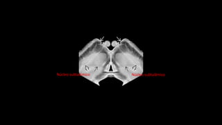 Núcleo subtalâmicoNúcleo subtalâmico
 