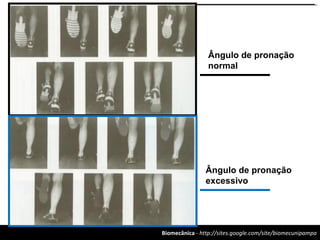 Biomecânica - http://sites.google.com/site/biomecunipampa
Ângulo de pronação
normal
Ângulo de pronação
excessivo
 