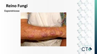 Reino Fungi
Esporotricose
 