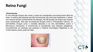 Reino Fungi
Onicomicose
É uma infecção fúngica das unhas, e pode ser considerada uma doença bem difícil de
tratar. A maioria das pessoas que têm onicomicose não procuram tratamento, e talvez
nem sequer tenham conhecimento da infecção. Há três grupos de fungos que causam
essa complicação. São eles as leveduras (fungos como o Trichophyton rubrum), os
dermatófitos (fungos como o Candida albicans) e os não dermatófitos (como o
Microascus brevicaulis). A onicomicose é considerada uma infecção patogênica,
principalmente em pessoas que possuem o sistema imunológico fragilizado e, em
muitos desses casos, pode ser fatal.
 