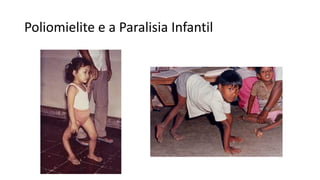 Poliomielite e a Paralisia Infantil
 