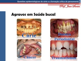Questões epidemiológicas da cárie e a formação crítica do pensamento
Agravos em Saúde bucal
Prof. Jean Santos
 
