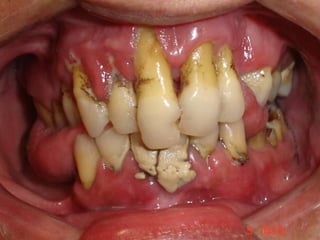 Questões epidemiológicas da cárie e a formação crítica do pensamento
 