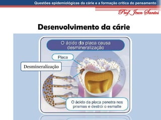 Questões epidemiológicas da cárie e a formação crítica do pensamento
Desenvolvimento da cárie
Desmineralização
Prof. Jean Santos
 