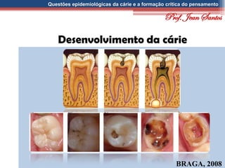 Questões epidemiológicas da cárie e a formação crítica do pensamento
Desenvolvimento da cárie
BRAGA, 2008
Prof. Jean Santos
 