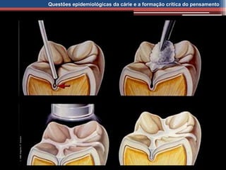 Questões epidemiológicas da cárie e a formação crítica do pensamento
 