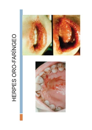 HERPESORO-FARÍNGEO
 