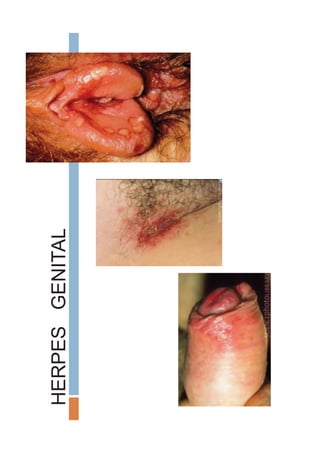 HERPESGENITAL
 