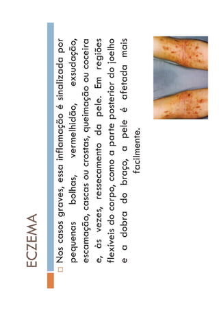 ECZEMA
…Noscasosgraves,essainflamaçãoésinalizadapor
pequenasbolhas,vermelhidão,exsudação,
escamação,cascasoucrostas,queimaçãooucoceira
e,àsvezes,ressecamentodapele.Emregiões
flexíveisdocorpo,comoaparteposteriordojoelho
eadobradobraço,apeleéafetadamais
facilmente.
 
