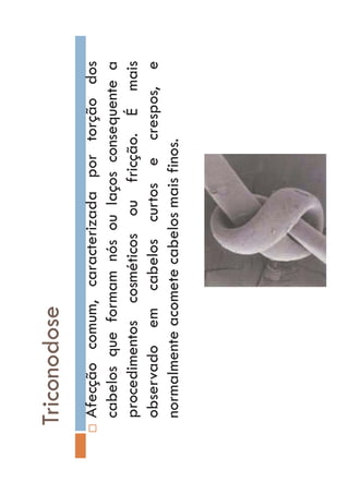 Triconodose
…Afecçãocomum,caracterizadaportorçãodos
cabelosqueformamnósoulaçosconsequentea
procedimentoscosméticosoufricção.Émais
observadoemcabeloscurtosecrespos,e
normalmenteacometecabelosmaisfinos.
 