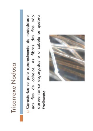 TricorrexeNodosa
…Caracteriza-sepeloaparecimentodenodosidade
nosfiosdecabelos.Asfibrasdosfiosvão
apresentar-seesgarçadaseocabelosequebra
facilmente.
 
