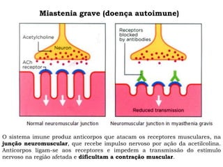 O sistema imune produz anticorpos que atacam os receptores musculares, na
junção neuromuscular, que recebe impulso nervoso por ação da acetilcolina.
Anticorpos ligam-se aos receptores e impedem a transmissão do estímulo
nervoso na região afetada e dificultam a contração muscular.
Miastenia grave (doença autoimune)
 