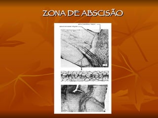 ZONA DE ABSCISÃO 