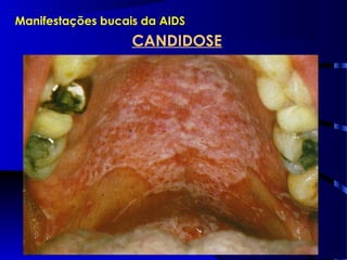 Manifestações bucais da AIDS
CANDIDOSE
 