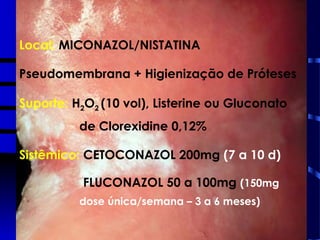 CANDIDOSES
PSEUDOMEMBRANOSA
ERITEMATOSA
OBS.: QUEILITE ANGULAR
Local: MICONAZOL/NISTATINA
Pseudomembrana + Higienização de Próteses
Suporte: H2O2 (10 vol), Listerine ou Gluconato
de Clorexidine 0,12%
Sistêmico: CETOCONAZOL 200mg (7 a 10 d)
FLUCONAZOL 50 a 100mg (150mg
dose única/semana – 3 a 6 meses)
 