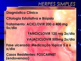 HERPES SIMPLES
Diagnóstico Clínico
Citologia Esfoliativa e Biópsia
Tratamento: ACICLOVIR 200 a 400 mg
5x/dia
FANCICLOVIR 125 mg 2x/dia
VALACICLOVIR 500mg 2x/dia
Fase ulcerada: Medicação tópica 5 a 6
x/dia
Casos Resistentes: FOSCARNET
(endovenoso)
 
