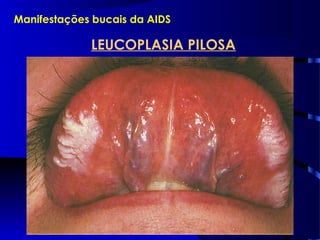 Manifestações bucais da AIDS
LEUCOPLASIA PILOSA
 