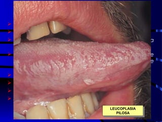LEUCOPLASIA PILOSA
 Epstein-Barr vírus
 Imunossupressão na fase assintomática
 Sinal patognomônico de desenvolvimento da
doença
 Lesões brancas não raspáveis, com superfície
irregular com hiperqueratose tipicamente
encontrada no bordo lateral da língua.
 Diagnóstico clínico, biópsia (EBV)
 Assintomática
 Antiviral só tem efeito durante o uso
 Tratamento: Controle clínico e Antimicótico
LEUCOPLASIA
PILOSA
LEUCOPLASIA
PILOSA
 