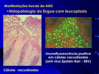Manifestações bucais da AIDS
•Histopatologia da língua com leucoplasia
Células vacuolizadas
Imunofluorescência positiva
em células vacuolizadas
(anti vírus Epstein-Barr - EBV)
 