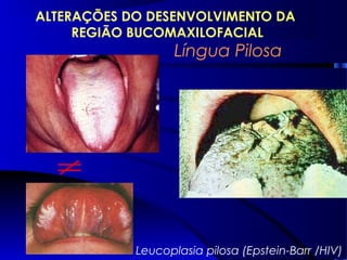 Língua Pilosa
ALTERAÇÕES DO DESENVOLVIMENTO DA
REGIÃO BUCOMAXILOFACIAL
Leucoplasia pilosa (Epstein-Barr /HIV)
 