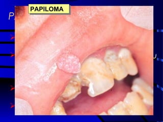PAPILOMA
 Papiloma vírus humano (HPV)
 Lesões verrucóides, pediculadas ou
sésseis
 Diagnóstico Clínico-laboratorial
 Tratamento: Excisão cirúrgica
PAPILOMAPAPILOMA
 