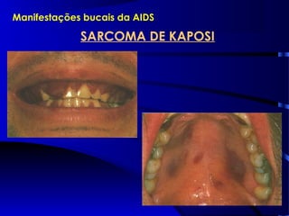 Manifestações bucais da AIDS
SARCOMA DE KAPOSI
 