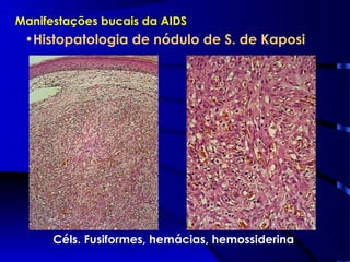 Manifestações bucais da AIDS
•Histopatologia de nódulo de S. de Kaposi
Céls. Fusiformes, hemácias, hemossiderina
 