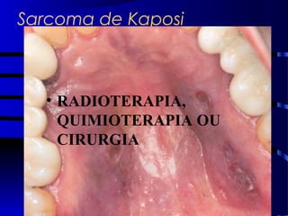 Sarcoma de Kaposi
• RADIOTERAPIA,
QUIMIOTERAPIA OU
CIRURGIA
 