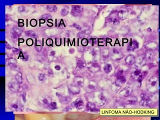 LINFOMA NÃO-HODKING
LINFOMA NÃO-HODKINGLINFOMA NÃO-HODKING
BIOPSIA
POLIQUIMIOTERAPI
A
 