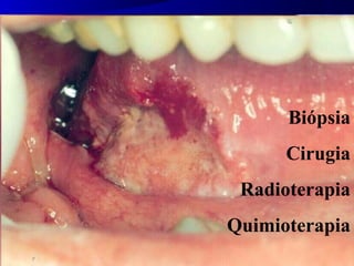 CA EPIDERMÓIDE
Biópsia
Cirugia
Radioterapia
Quimioterapia
 