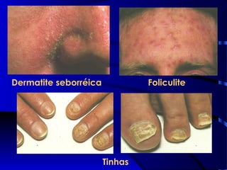 Dermatite seborréica Foliculite
Tinhas
 