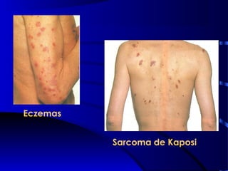 Eczemas
Sarcoma de Kaposi
 