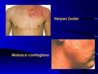 Herpes Zoster
Molusco contagioso
 