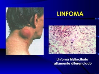 LINFOMA
Linfoma histiocitário
altamente diferenciado
 