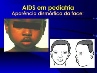 Aparência dismórfica da face:
AIDS em pediatria
 